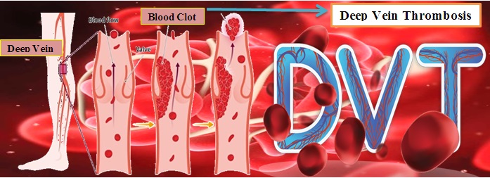 Comparison of the ultrasonography report by the emergency service with radiology service in suspected DVT patients: A cross sectional study for investigation about pharmaceutical and therapeutic interventions 