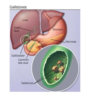 Evaluation of acute calculus cholecystitis in relation to calcium, body mass index and lipid profile in sample of Iraqi women 